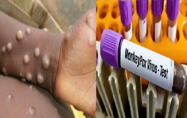 Union Health Ministry issued advisory after the first case of Mpox